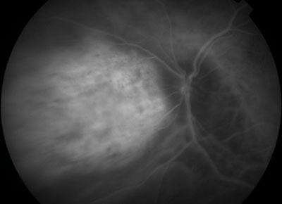 Figure 3. Indocyanine green angiography demonstrated a well-defined area