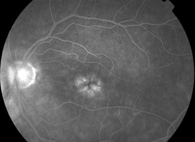 Figure 4. Fluorescein angiography (6 minutes, 22 seconds) demonstrated cystoid macular edema with leakage.