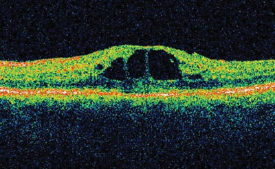 Figure 5. Optical coherence tomography demonstrated cystoid macular edema