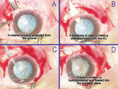 After a conjunctival peritomy is performed, a half-depth scleral groove is created