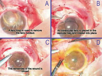 A lens loop is used to remove the lens nucleus