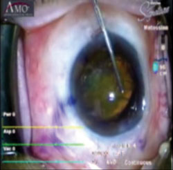 Healon5 coating leading edge of tilted cataract.