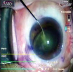 Lens being flipped where posterior surface of cataract now facing corneal apex