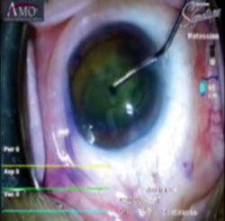 Healon5 being used to complete cleaving the sliced cataract into two semi-nuclei.