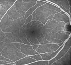 Figure 1a. Fluorescein angiography showing small transmission defects at the foveolae