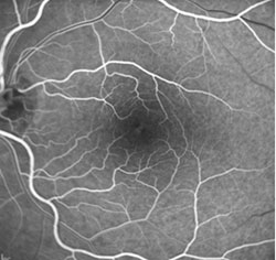 Figure 1b. Fluorescein angiography showing small transmission defects at the foveolae