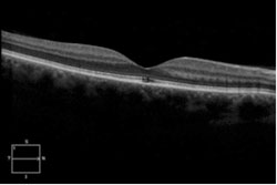 Figure 2a. Spectral-domain optical coherence tomography demonstrating disruptions