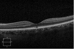 Figure 2b. Spectral-domain optical coherence tomography demonstrating disruptions