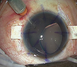 Figure 1. Coloboma of the lens. 