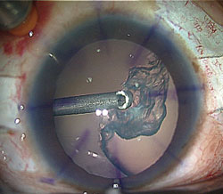 Figure 2. Lensectomy with vitrectomy.