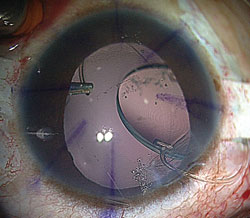 Figure 3. IOL haptic is externalized with 23-gauge MST forceps below the scleral flaps.