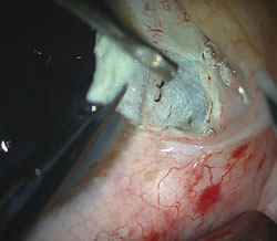 Figure 4. Haptics are tucked into the intralamellar scleral tunnel, and then fibrin glue is applied