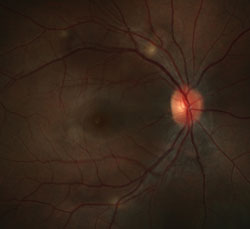 Figure 1a. Color fundus photograph