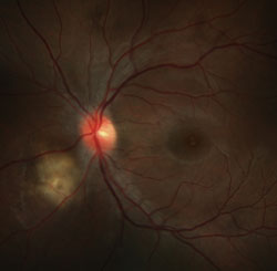 Figure 1b. Color fundus photograph