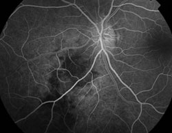 Figure 2a. Early and late fluorescein angiograph of the left eye.