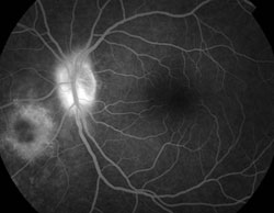 Figure 2b. Early and late fluorescein angiograph of the left eye.