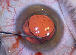 Figure 2. Viscoelastic dissection of the distal bulb