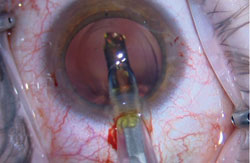 Figure 6. The new IOL is implanted using a D cartridge