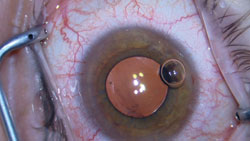 Figure 7. The end of the procedure shows the new IOL well-centered in the bag