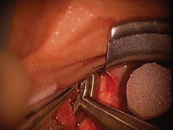 Figure 2. The resected fibrovascular tissue is grasped with 0.12 forceps