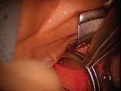 Figure 3. The clamp with the MMC-soaked sponge may be placed