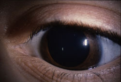 Figure 1b. Marked iris corectopia.