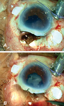 Figures 1a and 1b.  Expulsive hemorrhage.