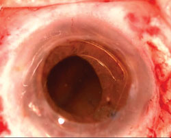 Figure 2. A dark, expanding choroidal mass is seen