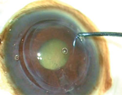 Figure 3. The donor cornea with a top hat-shaped cut created by the IntraLase is seen.