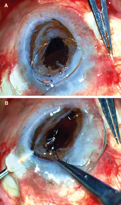 Figures 5a and 5b.  A combined penetrating keratoplasty with a glued IOL is seen.