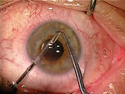 Figure 1. A peripheral iridotomy is created inferiorly