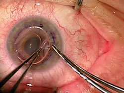 Figure 2. The donor tissue is brought to the surgical field