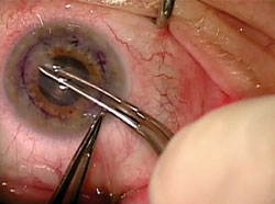 Figure 4. The donor button is inserted into the anterior chamber.