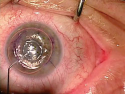 Figure 5. Air is injected into the anterior chamber underneath the graft