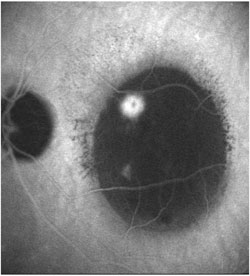 ICG angiography shows the characteristic appearance of  retinal angiomatous proliferation before the treatment