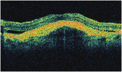 OCT shows the characteristic appearance of  retinal angiomatous proliferation before the treatment