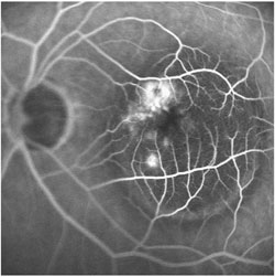 Fluorescein angiography shows the characteristic appearance of  retinal angiomatous proliferation before the treatment