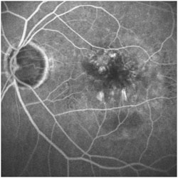 After the treatment with anti-VEGF injections, a recovery of the normal macular profile is visible.