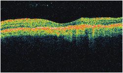 After the treatment with anti-VEGF injections, a recovery of the normal macular profile is visible.