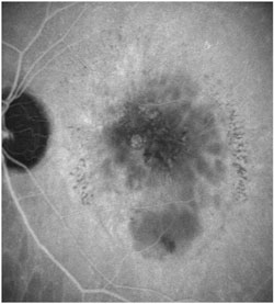 After the treatment with anti-VEGF injections, a recovery of the normal macular profile is visible.