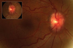 Figure 1a. Fundus examination of the right eye reveals optic disc hyperemia and swelling and collateral vessels