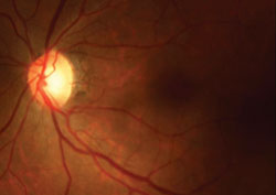 Figure 1b. Fundus examination of the left eye is normal except for mild cupping of the optic disc