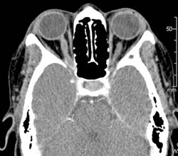 Figure 2. CT imaging of the brain