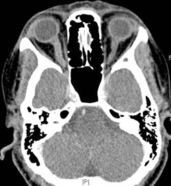 Figure 3. Follow-up CT imaging one year later 