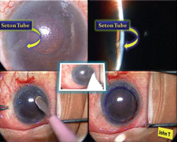 Figure 1. Top row: Severe pseudophakic bullous keratopathy