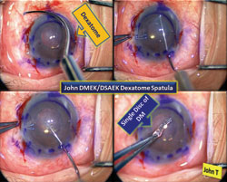 Figure 2. John DMEK/DSAEK Dexatome spatula