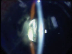 Figure 5.  Intraoperative slit lamp view of the ReSTOR