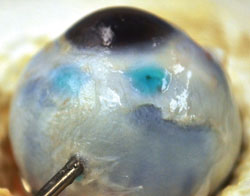 Experimental human cadaveric eye demonstrating ReSure Ocular Bandage sealing two 23-gauge MIVS sutureless vitrectomy ports.