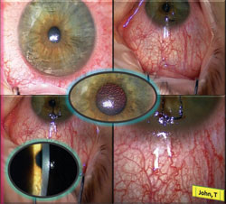 Figure 1. Intraoperative photographs of superior limbic keratoconjunctivitis