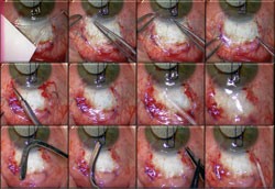 Figure 3. Top row: Amniotic membrane is placed to cover the bare sclera.